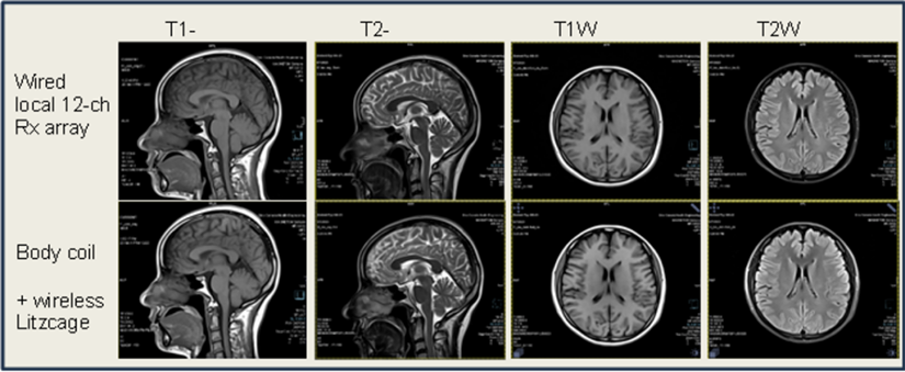 无线线圈与有线线圈对比图